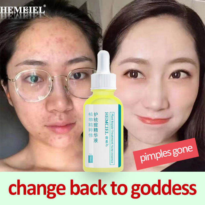 HEMEIEL Pimple Eraser Quick Fx/Anti Acne And Pimples/Tretinoin Cream