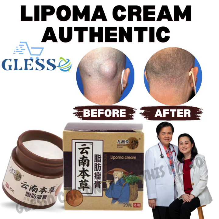 Lipoma Removal Cream Treat Tumor Skin Swelling Ointment Natural ...