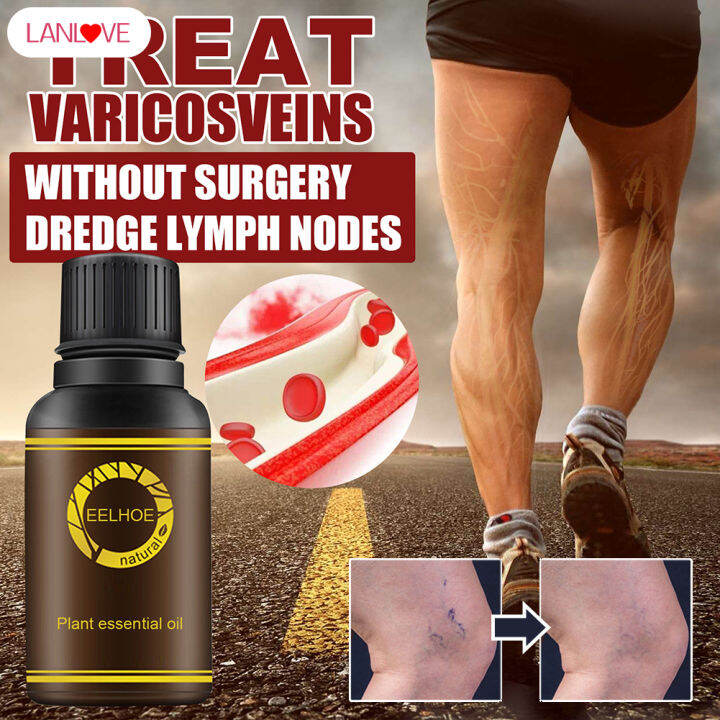 LANLOVE Varicose Veins Essence Oils For Inflammation Blood Vase