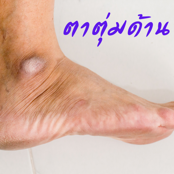 ครีมทาส้นเท้าแตก-ส้นเท้าแตก-หัวเข่าด้าน-ตาตุ่มดำ-ข้อศอกด้าน-ช่วยให้ผิว-ชุ่มชื่น-กิฟฟารีน-สกีนช้อฟเทนเนอร์-ครีมลบรอยกร้าน