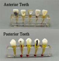 ภายในฟันหลังเยื่อทันตกรรมฟื้นฟูทางพยาธิวิทยาฟันที่ถอดออกได้ Dissecting Premolar ฟันโพรงเติม