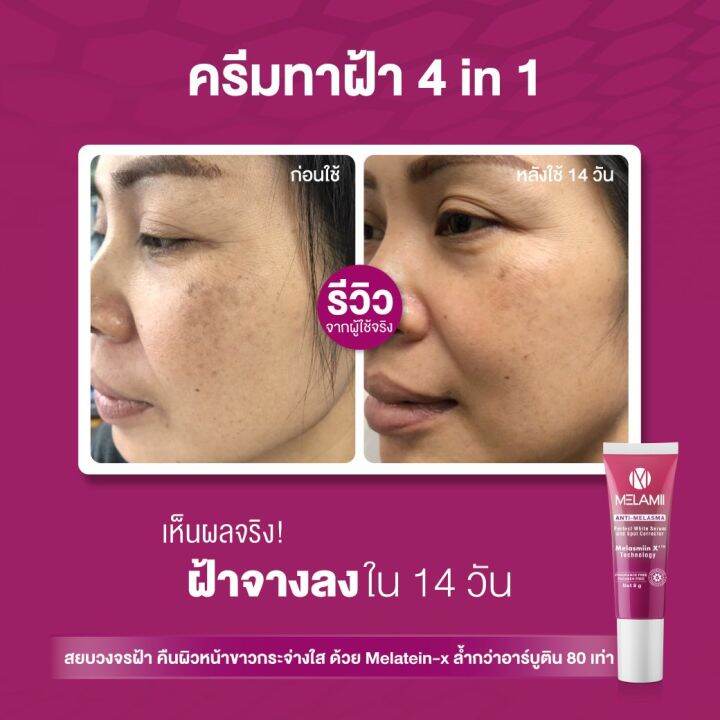 2-หลอด-melamii-anti-melasma-perfect-white-serum-เมลามิ-เซรั่ม-8-g-ลดเลือนฝ้า-กระ-ทาฝ้า