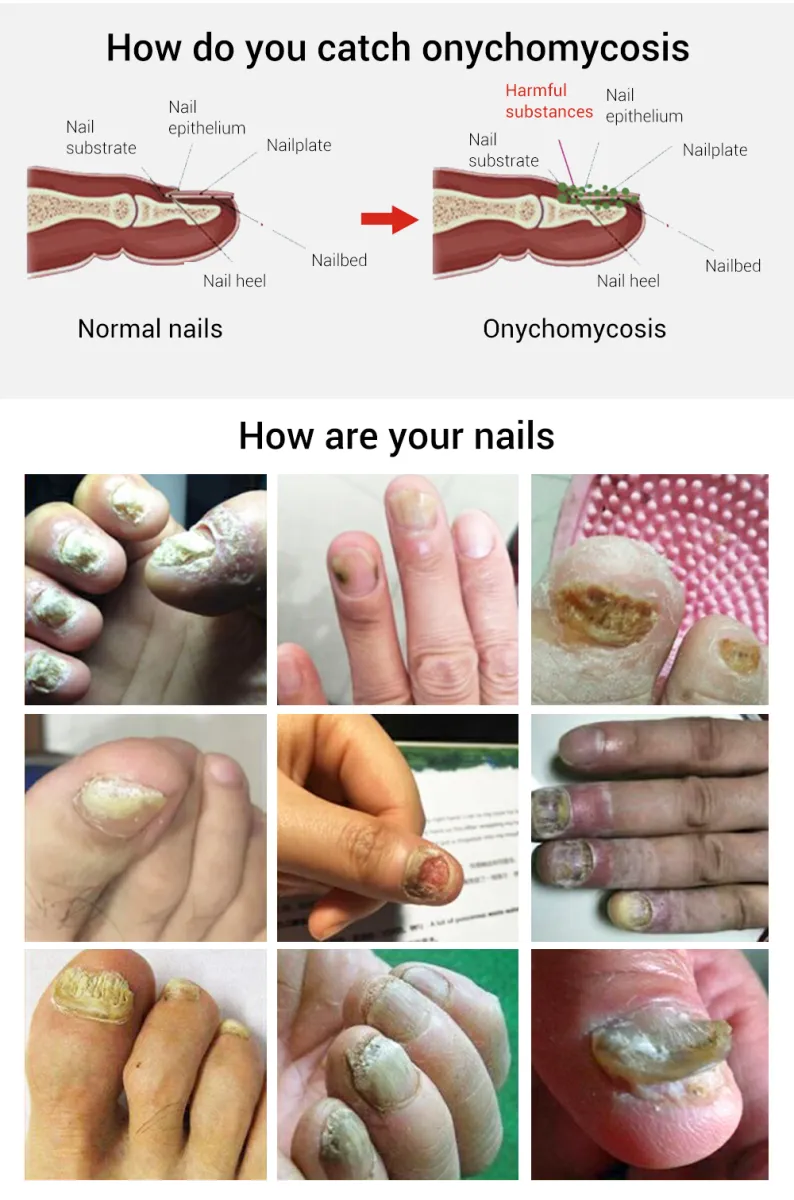 LANBENA Nail Care Gel Fungal Treatment Remove Onychomycosis Nourishing  Effective Against Soften Nails Treat Hand Foot Care 2Pcs | Lazada