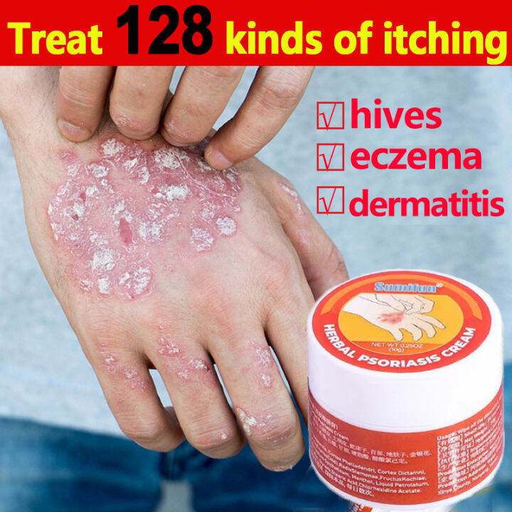 Psoriasis Cream Psoriasis Treatment Cream Psoriasis Eczema Cream Anti