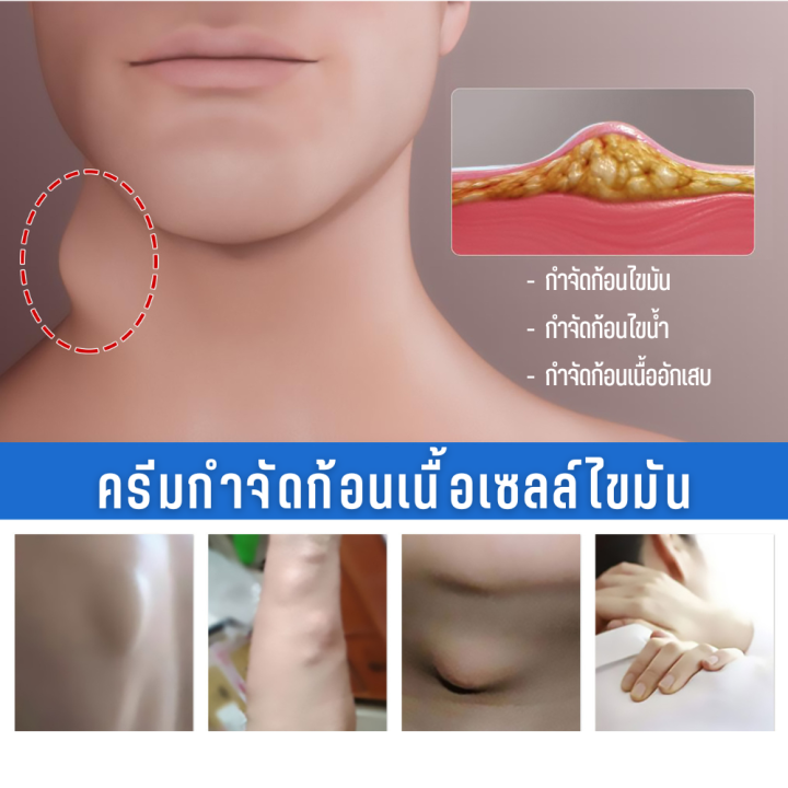 บรรเทาปูนปลาสเตอร์ผิวบวมครีมก้อนใต้ผิวหนัง-สารสกัดจากพืชธรรมชาติ-lipoma-treatment-balm-กำจัดเนื้องอกผิวหนังบวม-ทาแก้ปวด-บำรุงผิวกายเซลลูไลท์