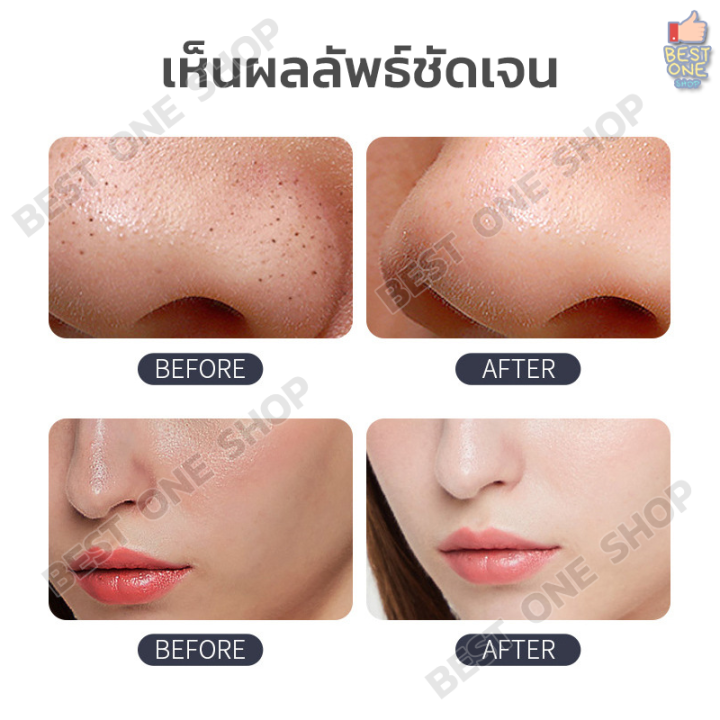 a180-เครื่องดูดสิวเสี้ยน-เครื่องดูดสิวไฟฟ้า-ปรับระดับได้-ดูดสิวเสี้ยน-สิวหัวดำ-สิวอุดตัน-สิ่งสกปรก-ที่ดูดสิวเสี้ยน