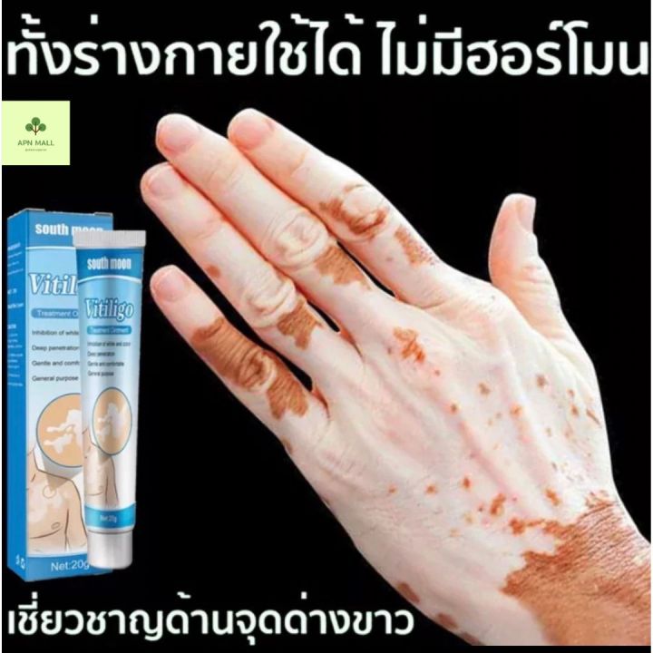 herbal-extract-vitiligo-ส่งทันที-south-moon-ครีมทาด่างขาว-ด่างขาวที่หน้า-ด่างขาวที่หลัง-ด่างขาวที่แขน-ด่างขาวที่ตัว