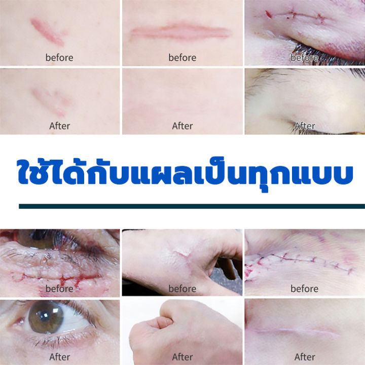 ฟื้นฟูผิวให้แข็งแรง-ครีมลดรอยแผล-50g-ยาทาแผลเป็น-ยาทาแผลเป็นนูน-ครีมลบรอยแผลเป็น-ลบรอยแผลเป็น-ครีมทาแผลเป็น-แผลไฟไหม้-คีลอยด์-ซ่อมแซมผิวที่เสียหาย-ครีมซ่อมแซม-แผลผ่าตัด-scar-cream