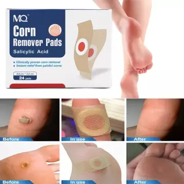 6Pcs Foot Corn Remover Pads Plantar Wart Thorn Plaster Patches Callus  Removal 