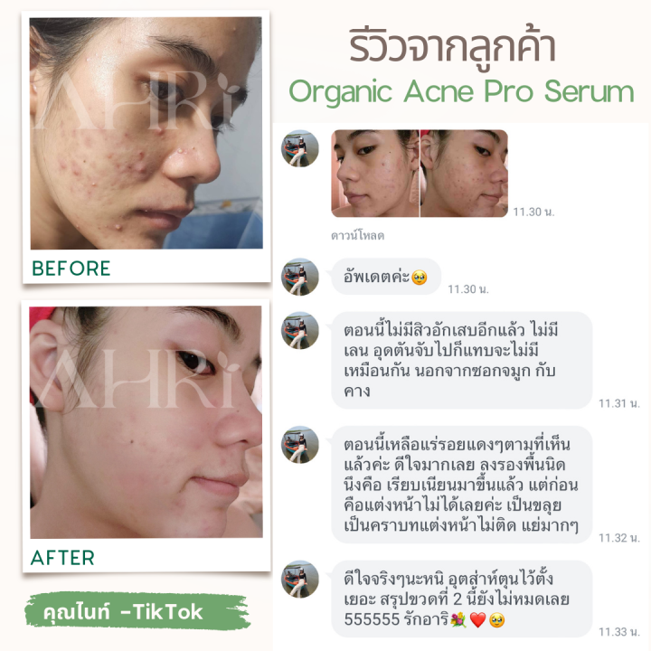 ahri-organic-acne-pro-serum-30ml-เซรั่มเคลียร์สิว-จากเภสัชกร-สูตรออร์แกนิค-อ่อนโยน-ใช้ได้แม้ผิวแพ้ง่าย