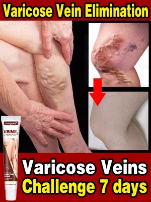 ครีม Relief เส้นเลือดขอดที่เท้าที่มีประสิทธิภาพกำจัด Vasculitis Phlebitis ขาแมงมุมทรีตเมนต์บรรเทาอาการปวดสบู่สมุนไพร