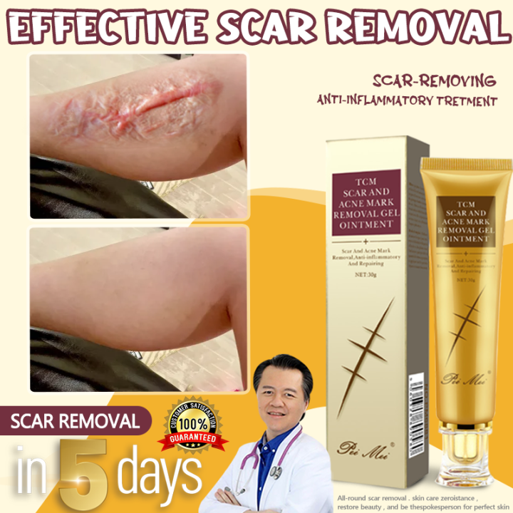 Scar Removal Cream Fix Scar Removal Scar Gel Cream Original Scar ...