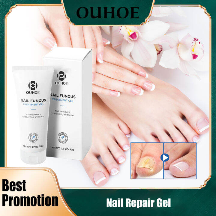 Ouhoe Nail Repair Gel Anti-Fungal Toe Removal Gel Anti Infection ...