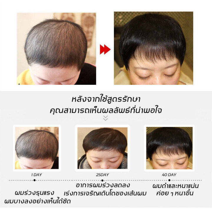 บอกลาหัวล้าน-eelhoe-สเปรย์ปลูกผม-เร่งผมขึ้นใหม่-เร่งผมยาวไว-ป้องกันผมร่วง-ป้องกันผมร่วงอย่างมืออาชีพ-แก้ปัญหาผมร่วง-ลดผมร่วง-น้ำยาใส่ผม-ยาปลูกผม-น้ำยาปลูกผม-น้ำยาเร่งผมยาว-เซรั่มปลูกผม-ปลูกผมเร่งด่วน-