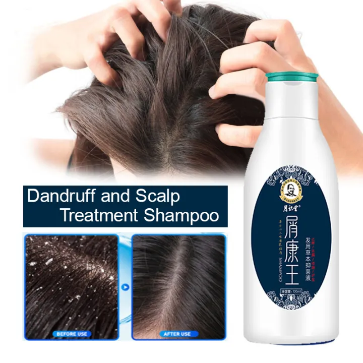 Anti Dandruff Shampoo For Dandruff and Scalp Treatment Fast Growth ...