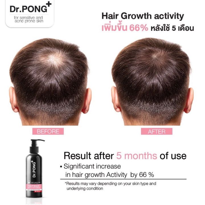 พร้อมส่ง-แชมพูลดผมร่วง-dr-pong-tsutsuji-gentle-shampoo-แชมพูลดผมร่วง-เพิ่มวอลุ่ม-anti-hairloss-shampoo