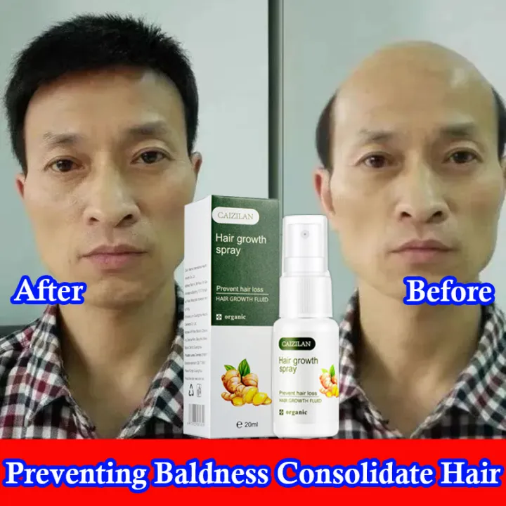 Hair Growth Spray Serum Essence For Men And Women Anti Preventing Hair Loss Alopecia Liquid