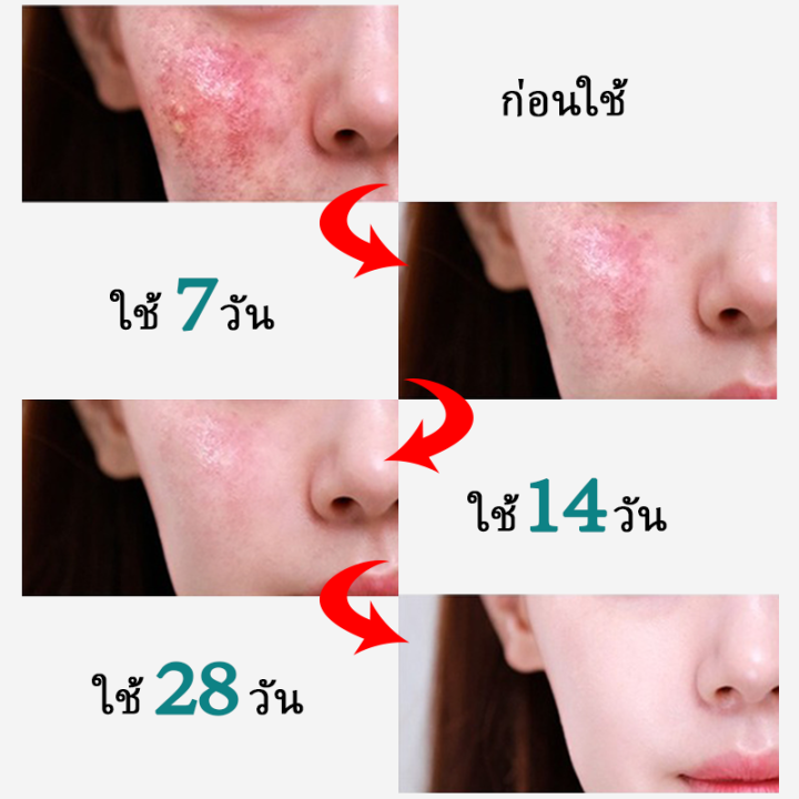 hemeiel-ลดสิว-รอยสิว-สำหรับสิวอักเสบ-เจลผักลดสิว-benzec-ละลายสิว