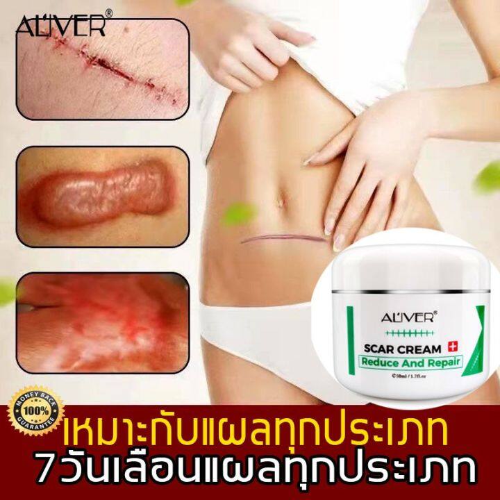 10วันเห็นผล-aliver-ครีมลดรอยแผลเป็น-50ml-แผลไฟไหม้-รอยสิว-รอยแตกลาย-รอยแผลเป็นเป็นต้น-ซ่อมแซมผิวหนัง-ช่วยให้แผลเป็นหายไปอย่างสมบูรณ์-แนะนำโดยหมอจีนเน้นยาโบราน-ครีมลดรอยสิว-ครีมทาแผลเป็น-ครีมบำรุงหน้า-