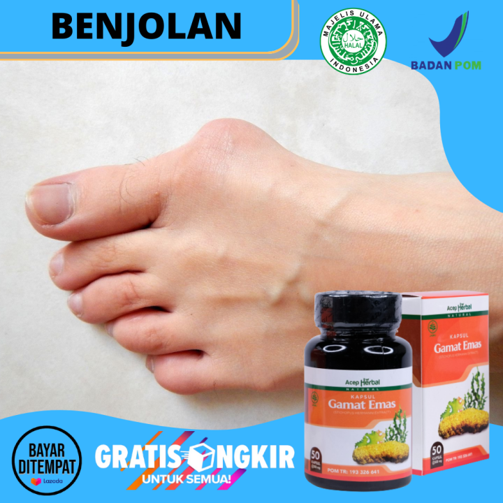 Obat Benjolan Di Kaki Penghilang Benjolan Di Mata Kaki Sebelah Kanan Kiri Ganglion Kelenjar