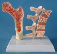 2 parts PVC Human Anatomical Model Osteoporosis Femur Leg Bone Spinal Section Specimen Diseased Lumbar Spine