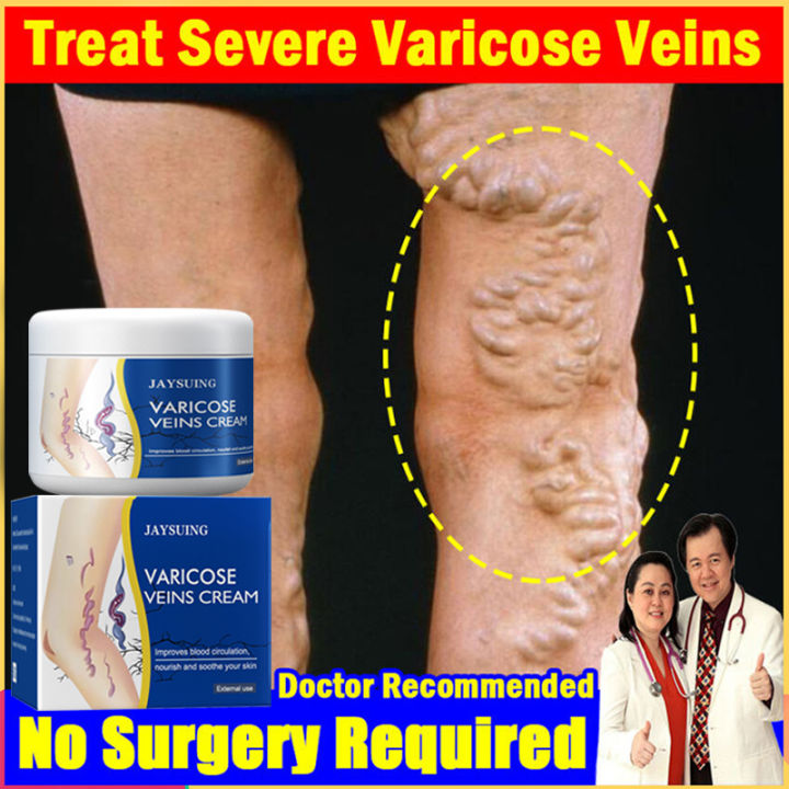 【Effective In 3 Days】Original JAYSUING Varicose Vein Treatment Cream ...