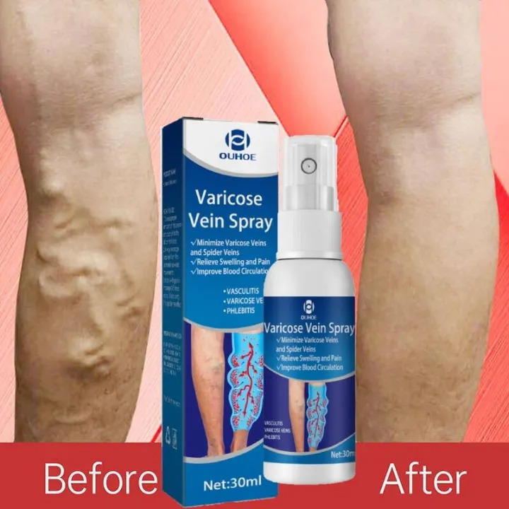 LADES【OUHOE】Varicose Veins Spayer Treatment Essential Oil Relief