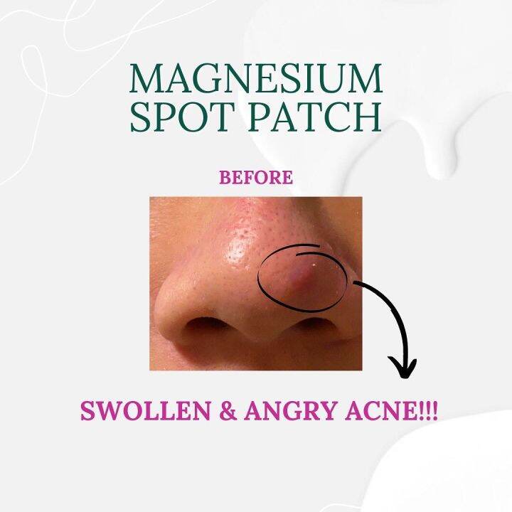 jyunka-magnesium-spot-patch-แผ่นแปะสิว-สิวอักเสบ