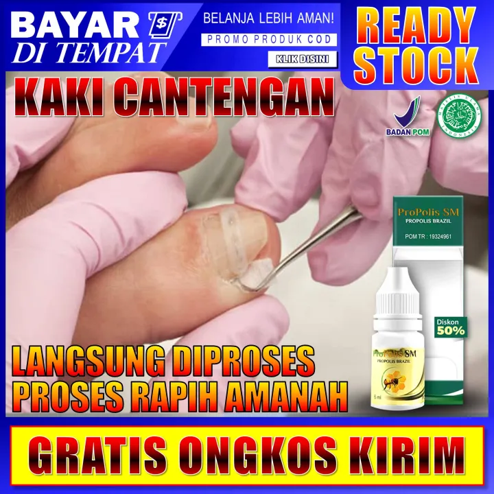 Cantengan: Mengatasi Gangguan Kuku yang Menyakitkan dengan Obat Herbal Alami