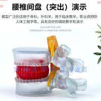 Transparent model of lumbar outstanding human lumbar demo model pathological lumbar spinal vertebral joints