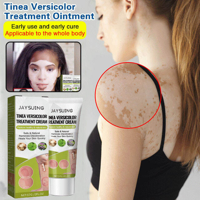 geegofirst [Plant Formula] Tinea Versicolor Treatment Ointment Vitiligo