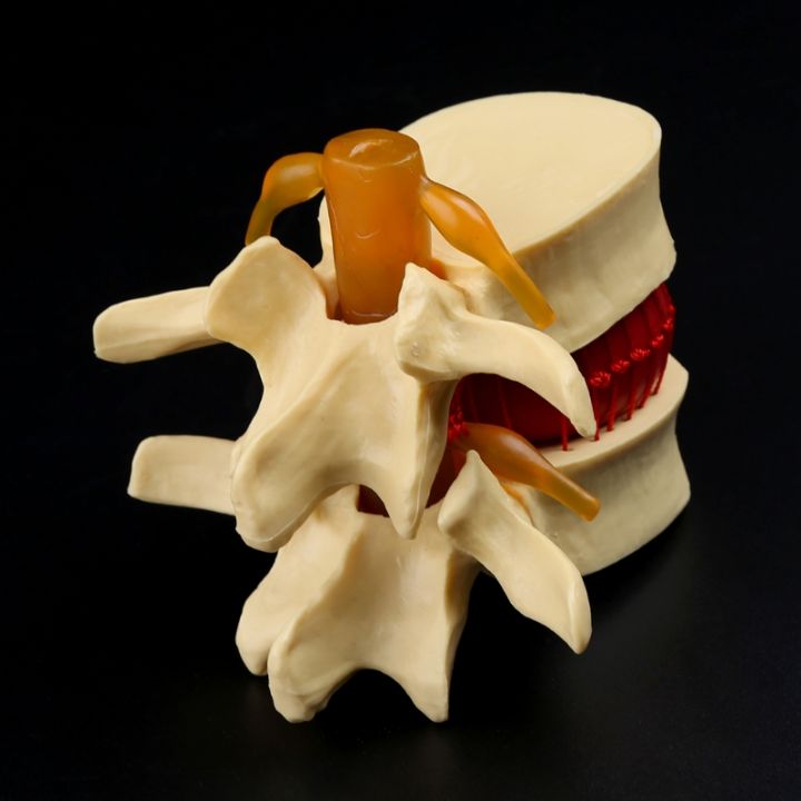 medical-props-model-free-postage-anatomical-spine-lumbar-disc-herniation-anatomy-medical-teaching-tool