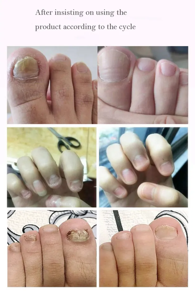 Details 124+ nail growth cycle best ceg.edu.vn