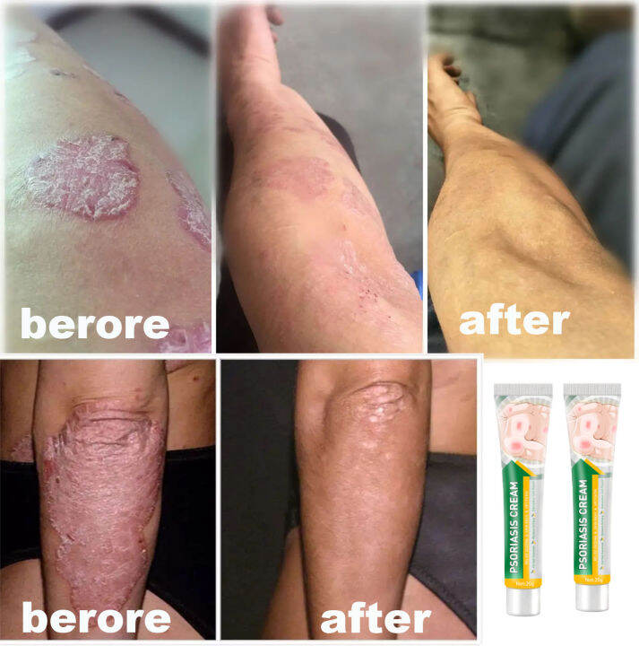 Get rid of psoriasis, psoriasis, dermatological ointment, prevent