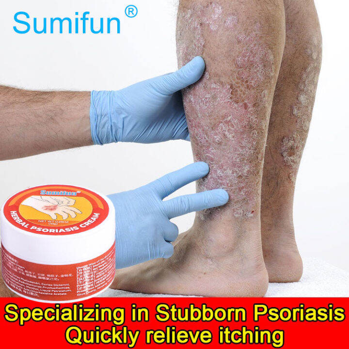 eczema treatment cream psoriasis treatment cream (ointment for itchy