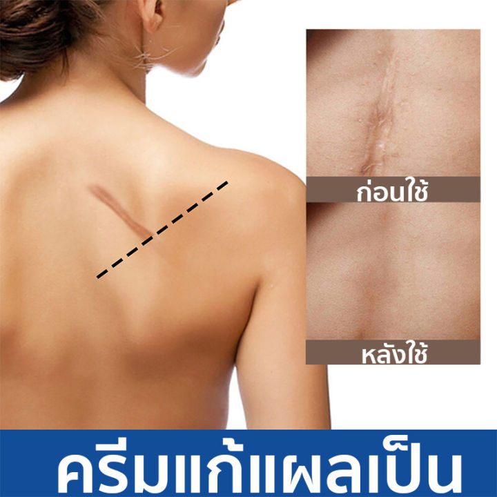 ฟื้นฟูผิวให้แข็งแรง-eelhoe-ครีมกำจัดรอยแผลเป็น-แผลเป็น-แผลเป็นจากการผ่าตัด-ครีมทารอยแผลเป็น-ซ่อมแซมผิวที่เสียหาย-ครีมทาแผลนูน-ครีมทาแผลเป็น-ครีมแผลเป็น-ยาทาแผลเป็นนูน-ครีมลบรอยแผล-ครีมลบรอยแผลเป็น-ครี