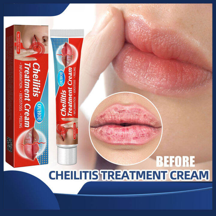 OUHOE Cheilitis Treatment Cream Herpes Antibacterials Ointment Chapped