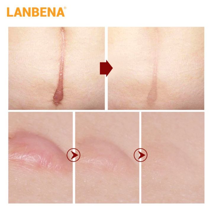 lanbena-tcm-ครีมกำจัดรอยแผลเป็นจากสิว-รักษาสิวหัวดำ-ลดรูขุมขน-ไวท์เทนนิ่ง-ให้ความชุ่มชื้นดูแลผิว-40-กรัม