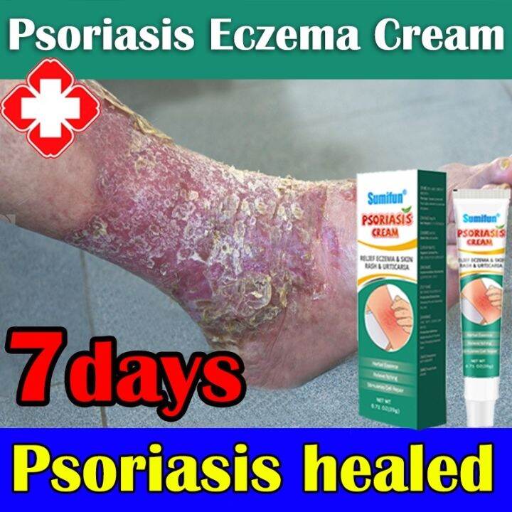 Psoriasis Eczema Cream Antiitching Antibacterial Atoderma Ointment