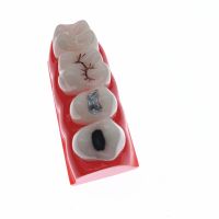 Dental Study Model For Pit And Fissure Sealing Treatment Teeth Model 2018