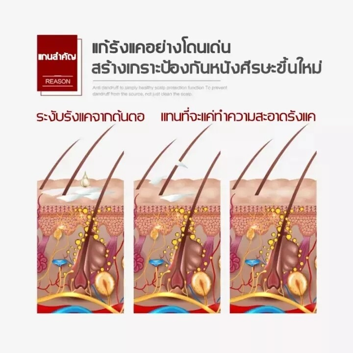 แชมพูขจัดรังแค-แชมพูสระผม-ยาสระผมเชื้อรา-แชมพูยาขจัดรังแค-มีรังแค-ป้องกันรังแค-ขจัดไร-ควบคุมความมันและอาการคัน-ครีมสระผม-ครีมขจัดรังแค-ยาสระผม-shampoo-แชมพูแก้ผมร่วง-500ml