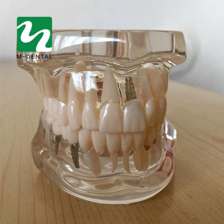ฟันศึกษาฟันใสผู้ใหญ่ทางพยาธิวิทยาฟันรุ่นเหมาะสำหรับผู้ใหญ่การเรียนการสอน