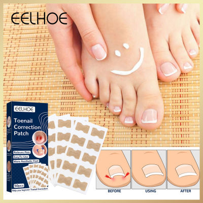 zx_Beauty shop Toe Nail Correction Patch Foot Care Pedicure Tool Fixer Ingrown Toenail Corrector Sticker Paronychia Recover Toenail Elastic Patch Corrector Anti-roll Nail Free Glue Toe Inlay Nail Corrector Patch