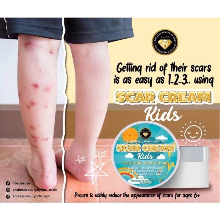 SCAR CREAM Fader for Kids 6yrs UP! Lightens Scars/Elbows/Knees/peklat remover whitening Lazada PH
