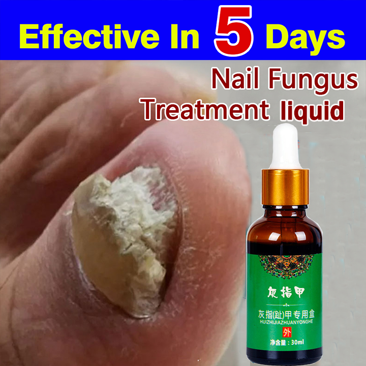 ORIGINAL30ml XUNYANGJIAN Nail Fungal Solution Foot Nail Fungus Removal ...