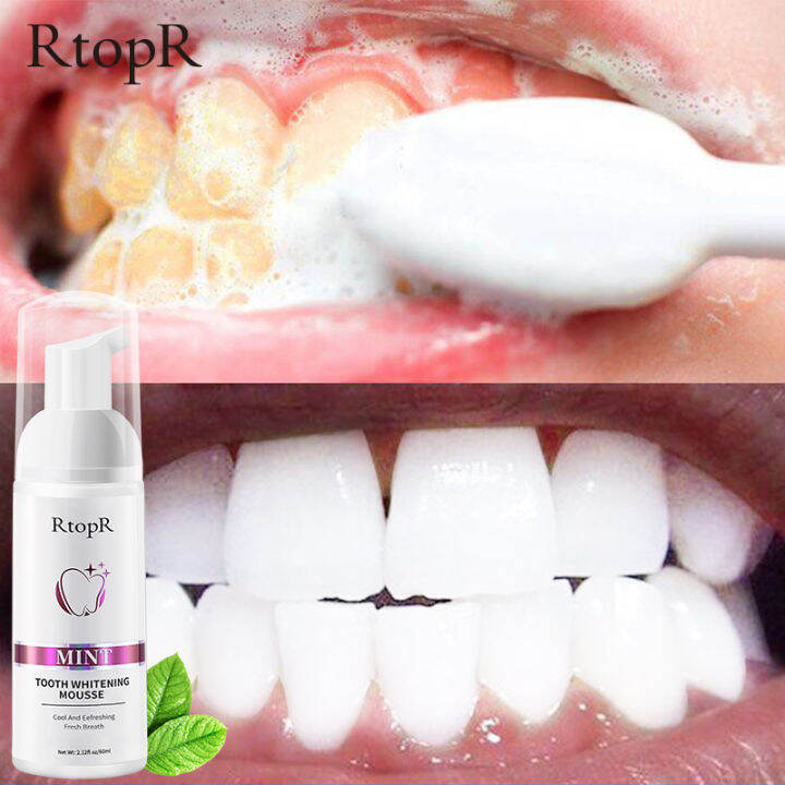 Teeth Cleansing Stains Oral cleaning Teeth whitening Remove tooth