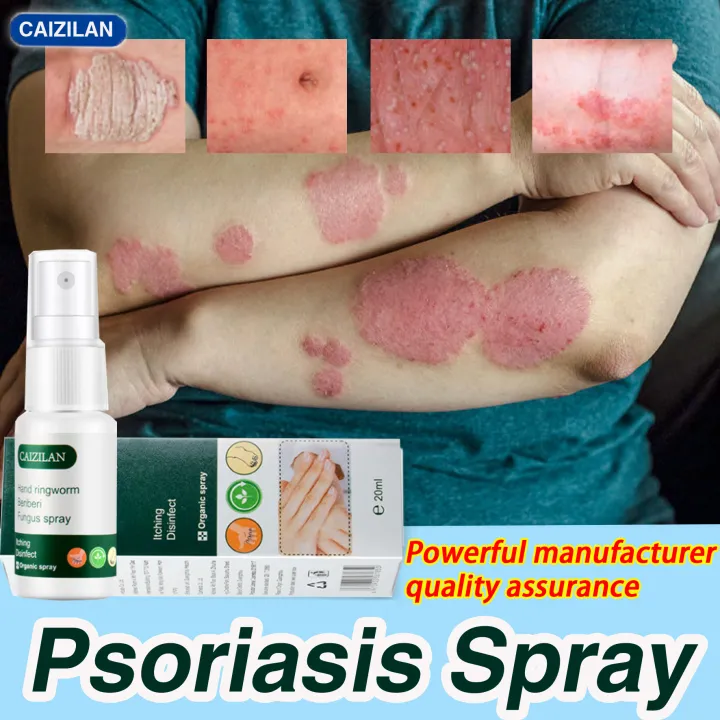 rash itching antibacterial genuine Stinky feet, itchy feet, peeling