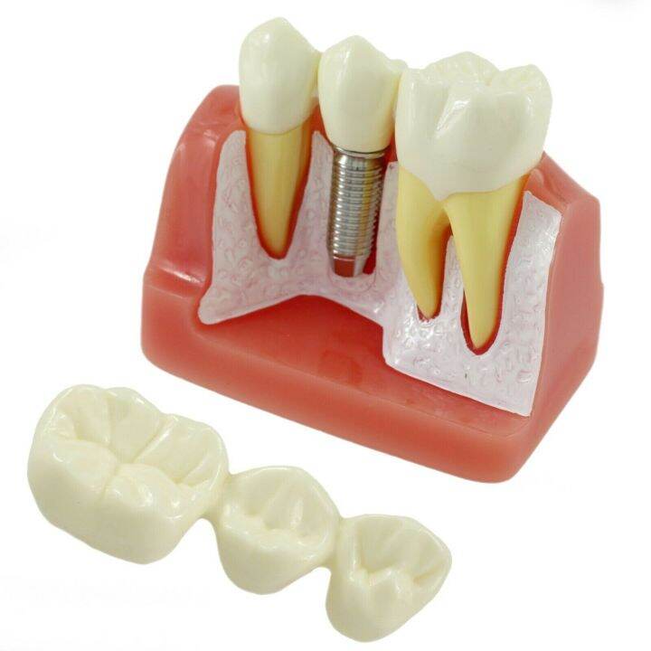 Cesoon 1pc Dental Implant Tooth Model Typodont Teeth Bridge M2017 