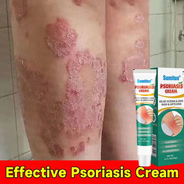 Sumifun Dermatitis Cream psoriasis eczema original cream Antiitching