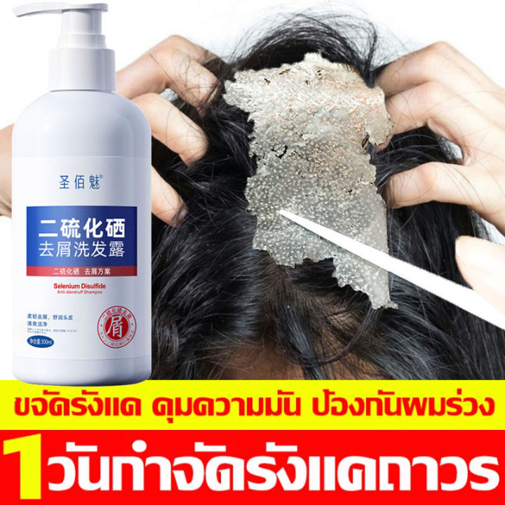 1ขวดแก้ปัญหาศีรษะหลายอย่าง-sbm-แชมพูขจัดรังแค-300ml-ยาสระผมรังแค-สำหรับคันหนังศีรษะโรคอักเสบรูขุมขนหนังศีรษะ-เชื้อราบนศีรษะ-แชมพูแก้เชื้อรา-ลดรังแคฆ่าเชื้อแก้คัน-ยาสระผมแก้เชื้อรา-ยาสระผมสมุนไพร-แชมพู